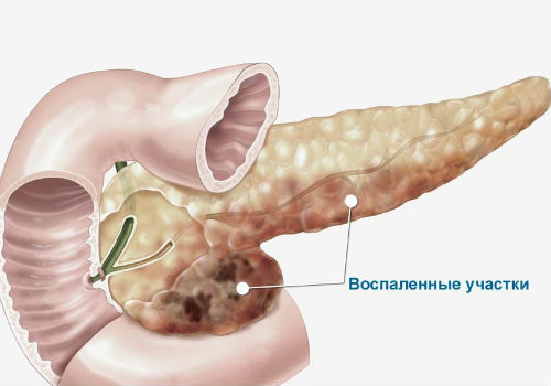 воспаление поджелудочной