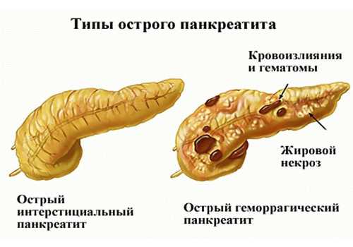 разновидности заболевания