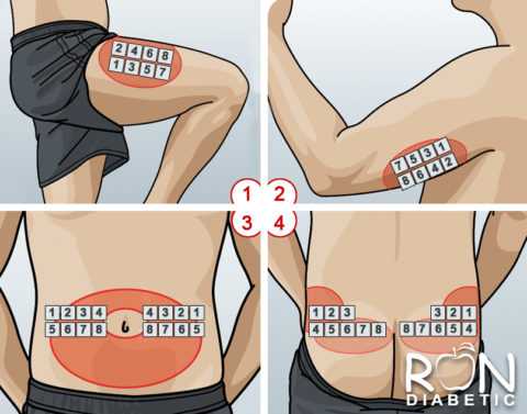 Пациент должен регулярно менять участки введения инъекций инсулина. Пациент должен регулярно менять участки введения инъекций инсулина.