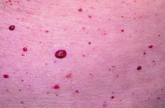 Симптом Тужилина