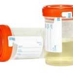 Плотность мочи при заболевании значительно ниже нормы – 1010 и менее