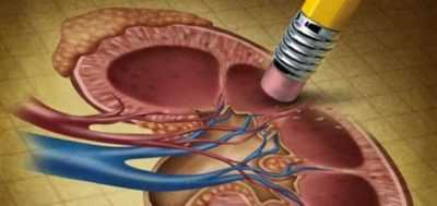Болезнь почек при сахарном диабете