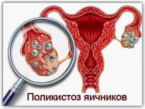 Поликистоз яичников. Поликистоз яичников.
