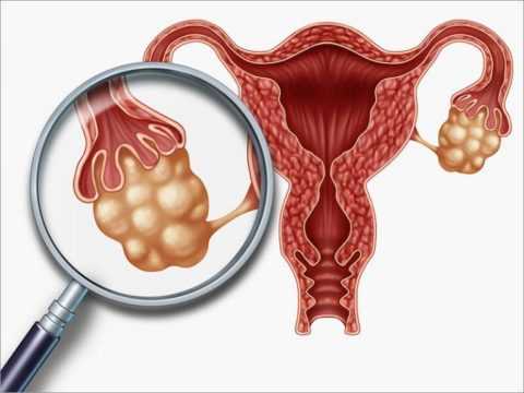 Поликистоз яичников – чем опасен. Поликистоз яичников – чем опасен.