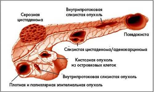 Разновидности кист поджелудочной