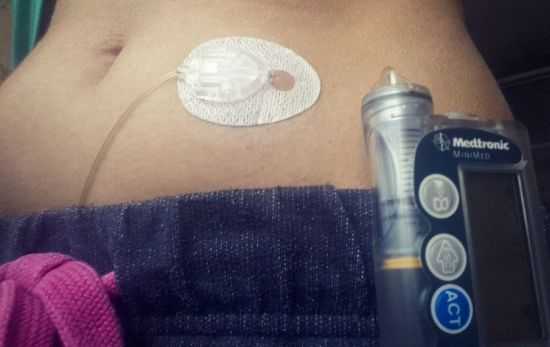 Инсулиновая помпа