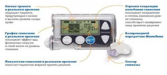 Принцип работы инсулиновой помпы третьего поколения