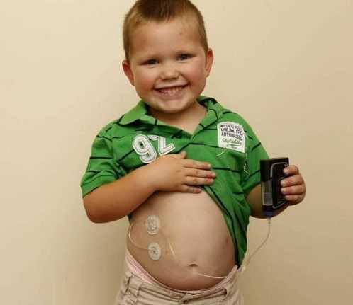 Инсулиновая помпа