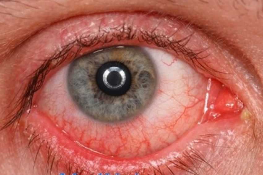 Хронические осложнения