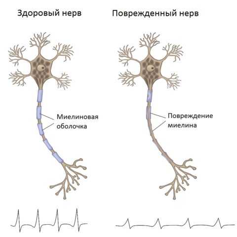 Поврежденная миелиновая оболочка нерва не позволяет рассеиваться импульсу
