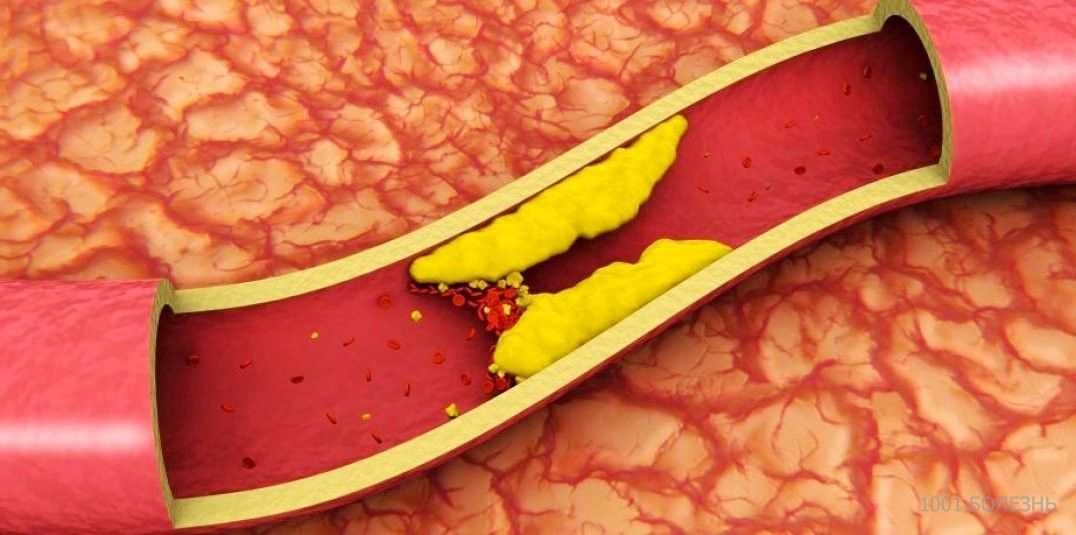 Чем опасно повышение холестерина в крови