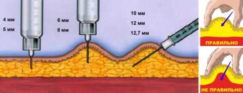 Правильная техника подкожных уколов взрослым в зависимости от длины иголки Правильная техника подкожных уколов взрослым в зависимости от длины иголки