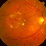 Препролиферативная стадия