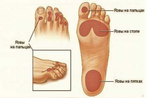 Прежде чем клеить китайский пластырь на язвы, получите одобрение лечащего врача