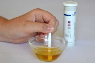 Осложнения при сахарном диабете: ацетон в моче