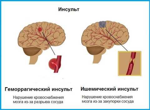 Причины геморрагического и ишемического инсульта Причины геморрагического и ишемического инсульта