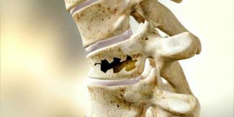 Причины хрупкости кости.