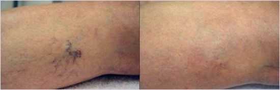 Сосудистые звездочки