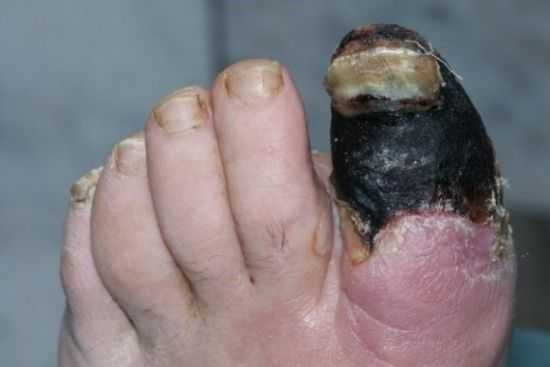 Гангрена пальца