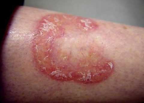 Прогрессивный липоидный некробиоз