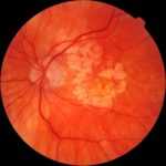 Пролиферативная стадия