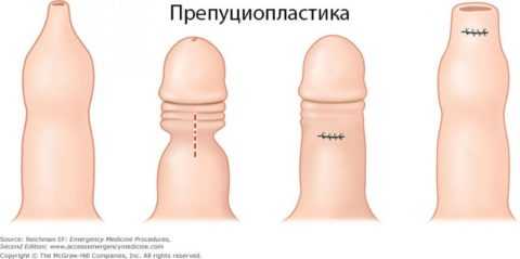Проведение препуциоплатики Проведение препуциоплатики