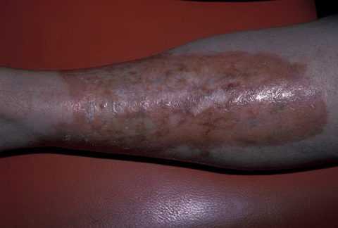 Проявление диабетической липодистрофии