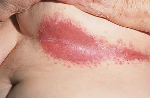 Проявление кандидоза в области крупных складок Проявление кандидоза в области крупных складок