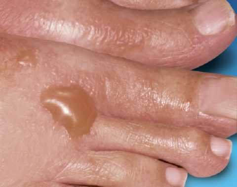 Пузыри на коже  при СД