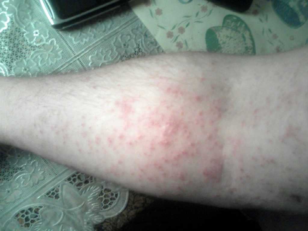 Пузырчатка