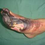 Пятая стадия: распространение гангрены вверх по ноге