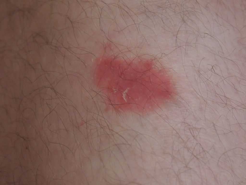 Липоидный некробиоз