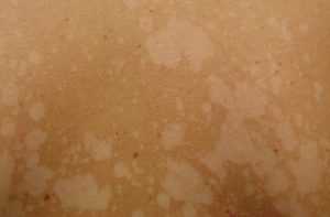 Пятна и язвы на коже при сахарном диабете