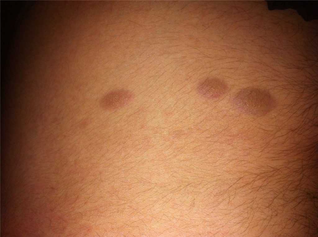 Дермопатия диабетическая