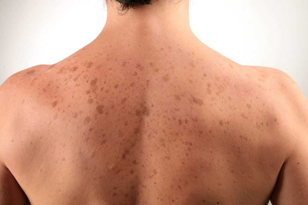 Пятна на теле