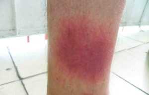 Пятна на ногах при сахарном диабете