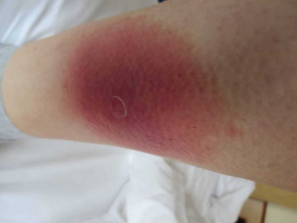 Липоидный некробиоз