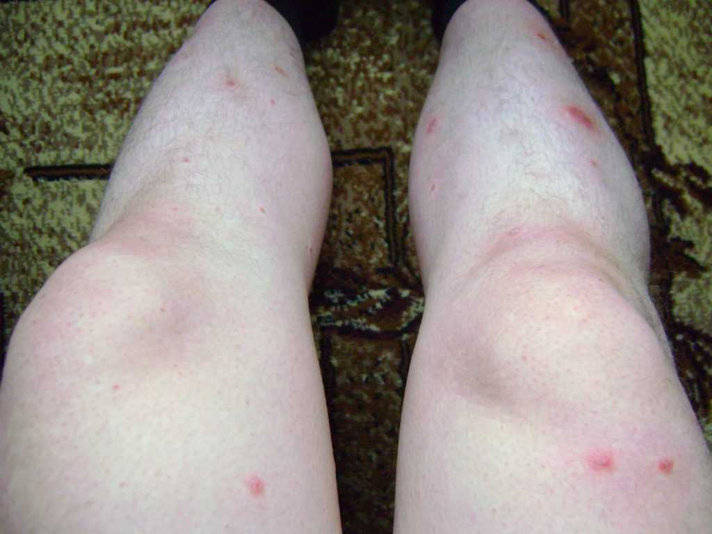 Нейродермит