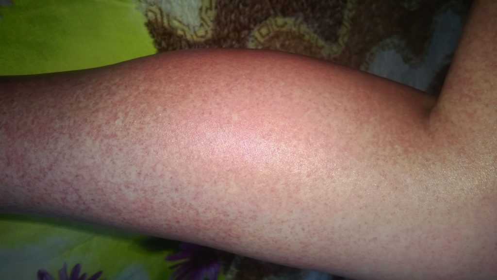 Причина появления пятен