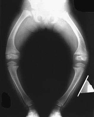 oslozhneniya-pri-fosfat-diabete
