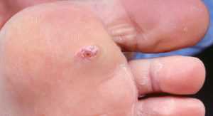 Чем обработать раны при диабете, ранозаживляющие мази