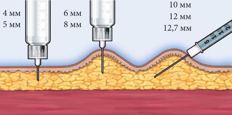 размер иглы для инсулина