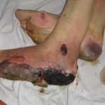 Развитие гангрены на ограниченных участках на четвертой стадии