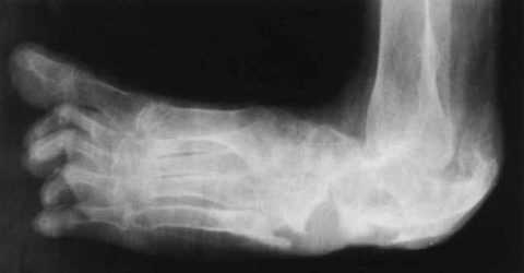 Рентгенография стопы Шарко Рентгенография стопы Шарко