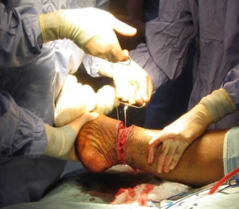 Резекция ступни Резекция ступни