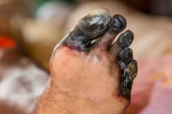 Гангрена пальцев стопы