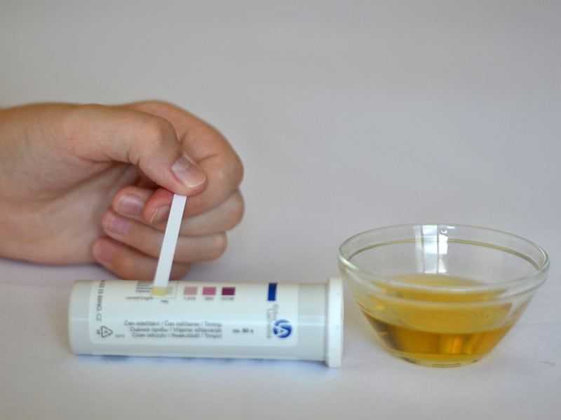 Что такое глюкозурия