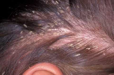 Шелушение и оголение кожи на голове