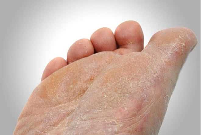 Шелушение ног при диабете