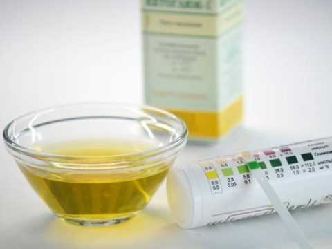 Содержание сахара в моче раздражает слизистую и провоцирует образование баланопостита.